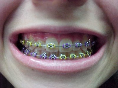 Braces Neon Colors